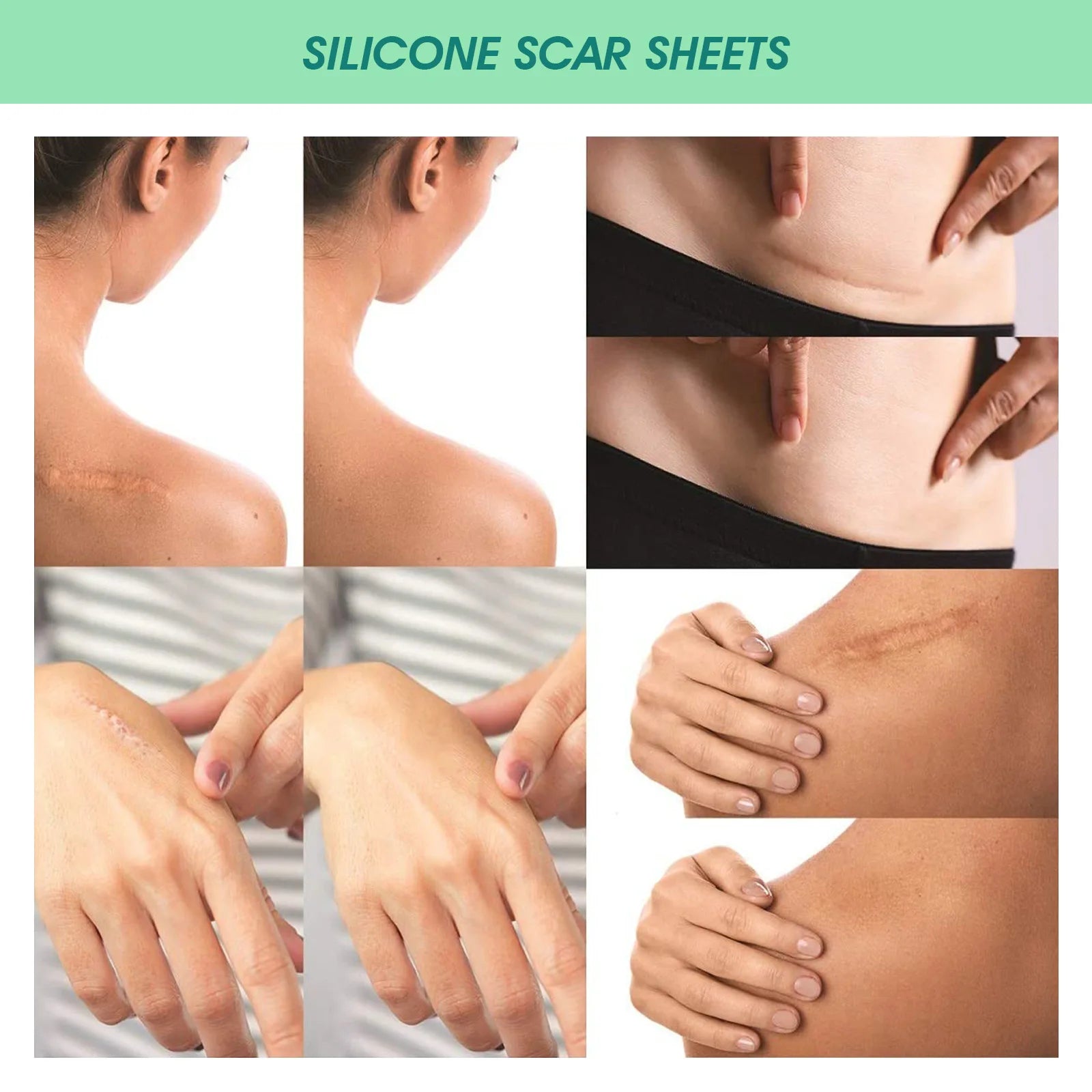 ClearSkin Scar Patches